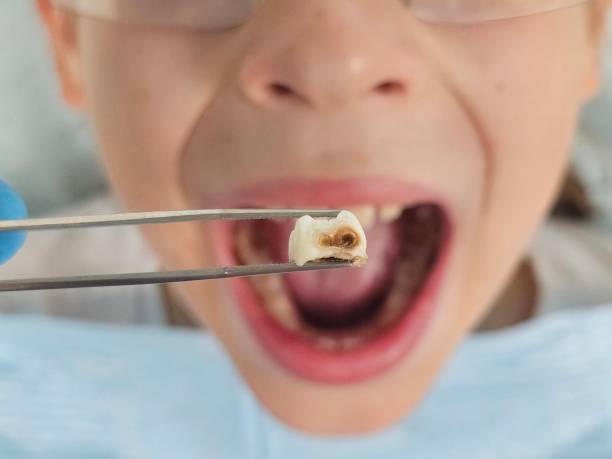 Best Knocked-Out Tooth (Avulsed Tooth) Treatment in Poughkeepsie, NY